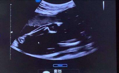 gestation pour autrui gpa
