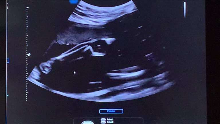 gestation pour autrui gpa