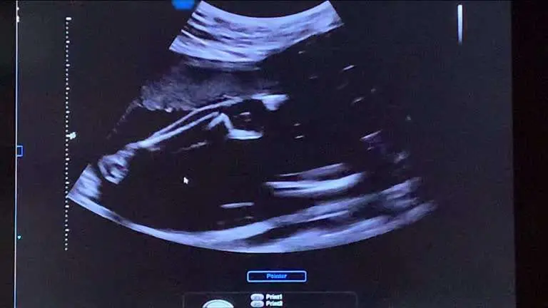 gestation pour autrui gpa