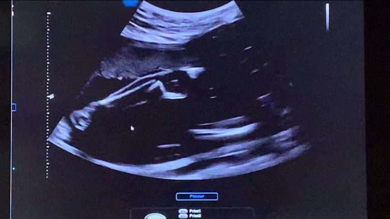 gestation pour autrui gpa